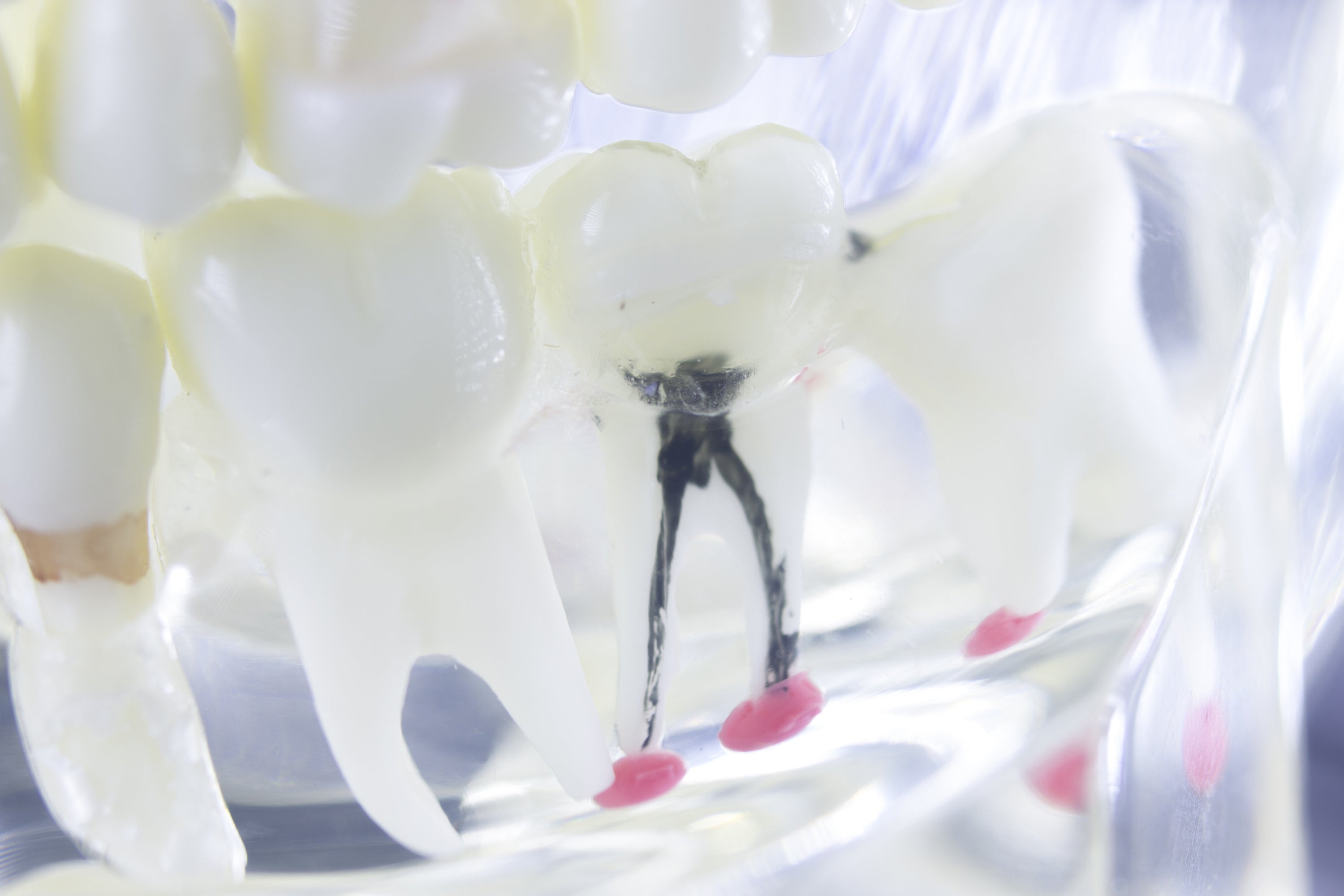 The good the bad and the ugly about root canals