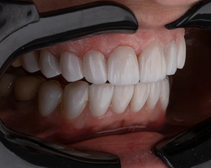 Conquering Teeth Sensitivity Essential Care Tips